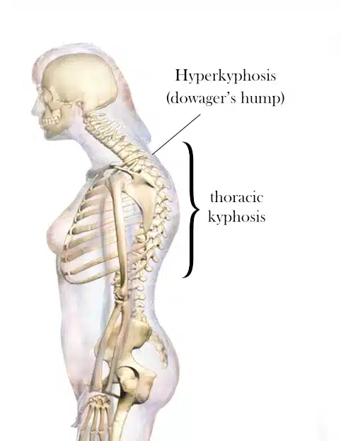Dowagers-hump Medical illustration of a female upper body skeleton showing exaggerated forward curve of the upper spine, labeled as hyperkyphosis (dowager’s hump) and thoracic kyphosis.
